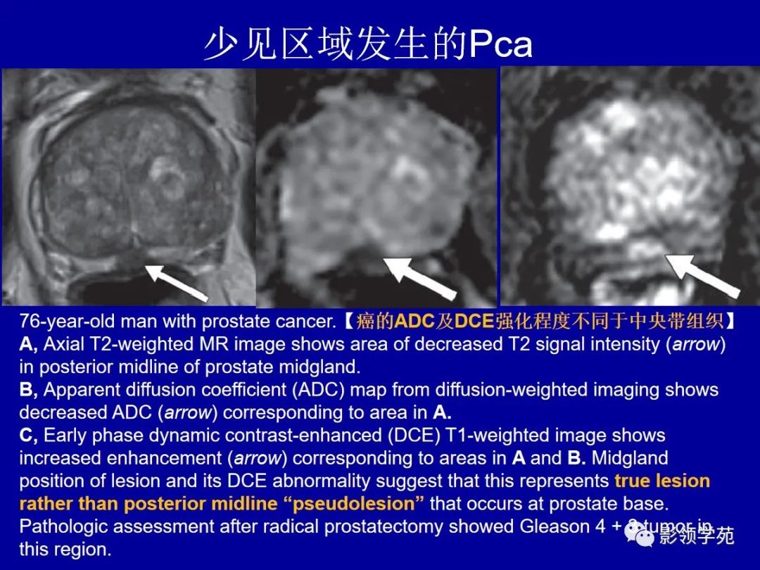 【PPT】前列腺癌MRI诊断再认识-103