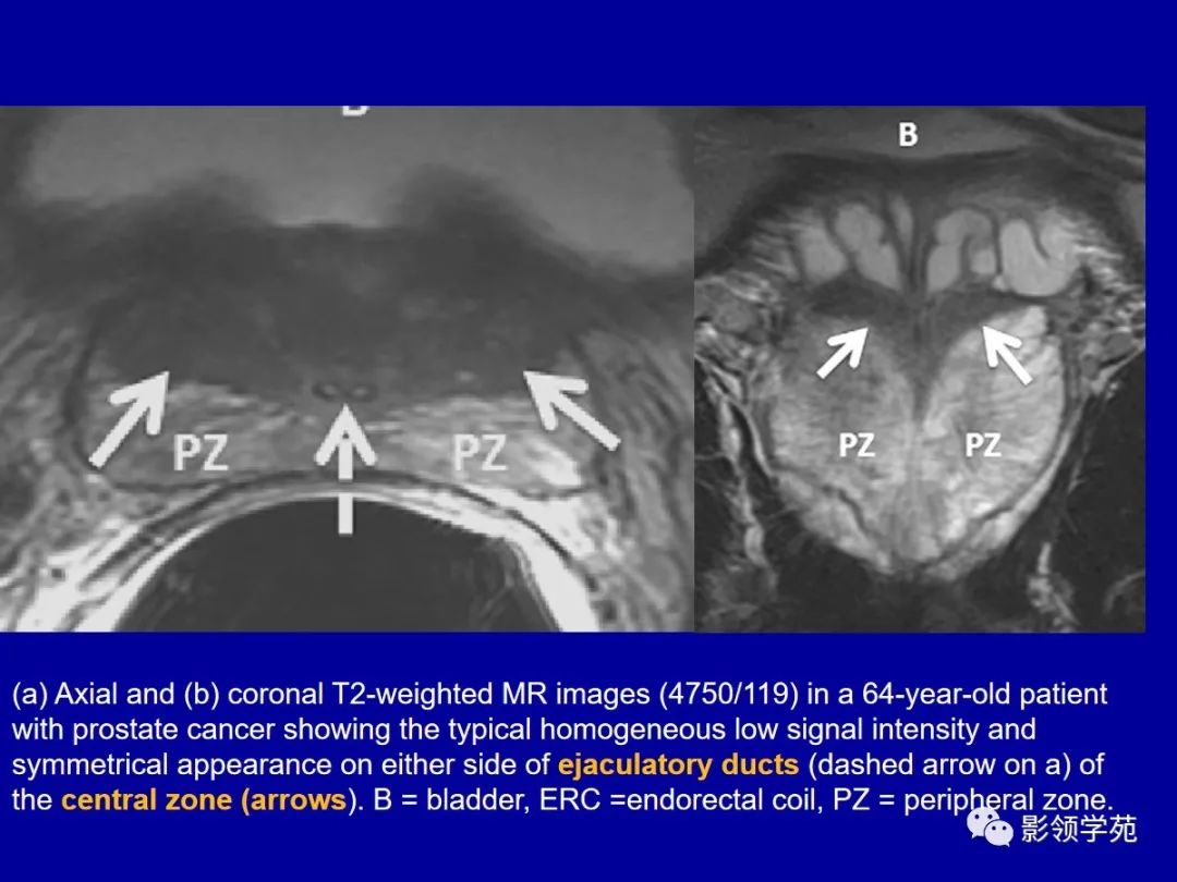 【PPT】前列腺癌MRI诊断再认识-101