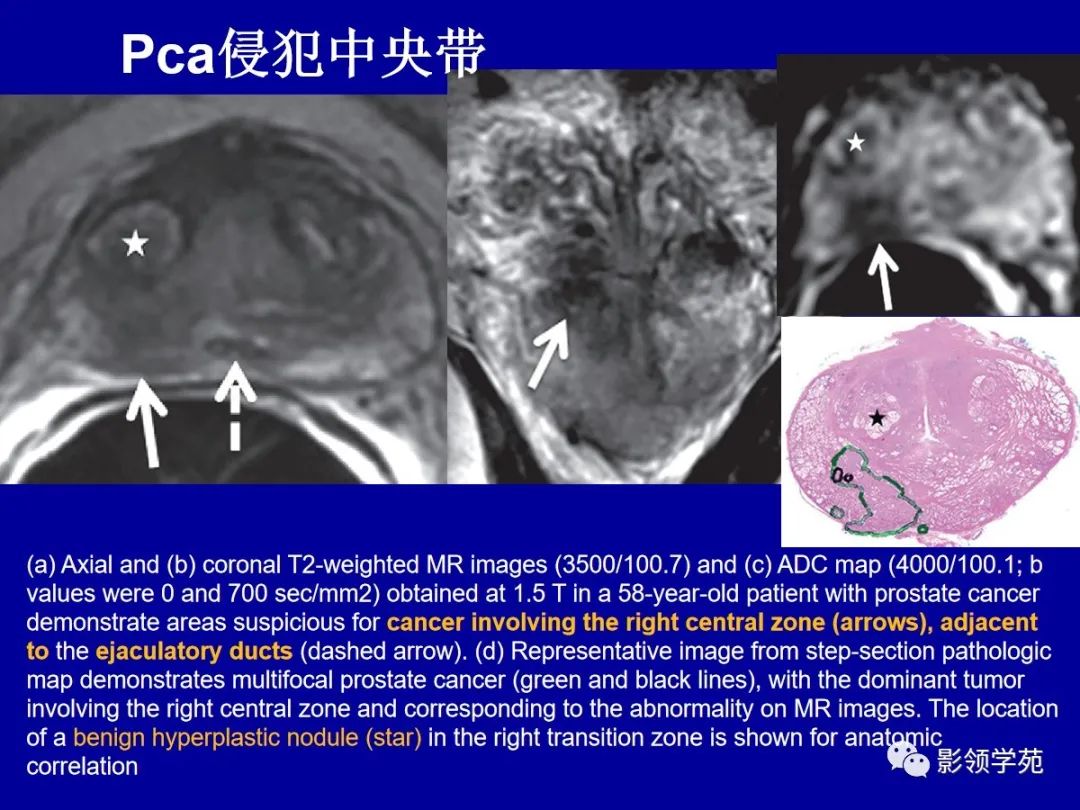 【PPT】前列腺癌MRI诊断再认识-102