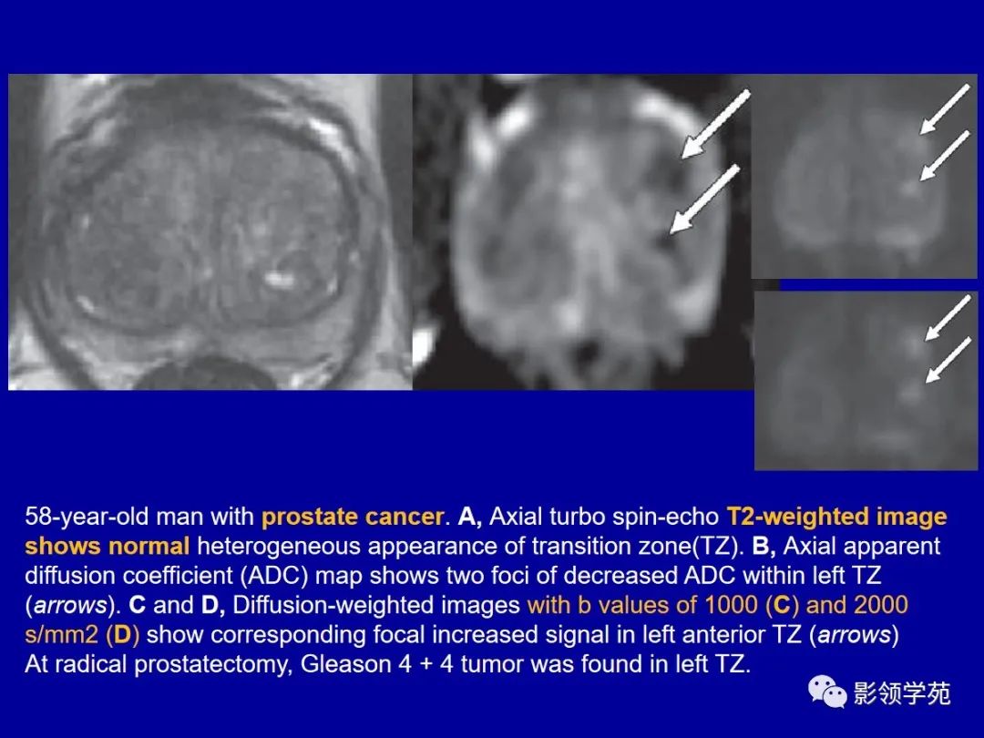 【PPT】前列腺癌MRI诊断再认识-108