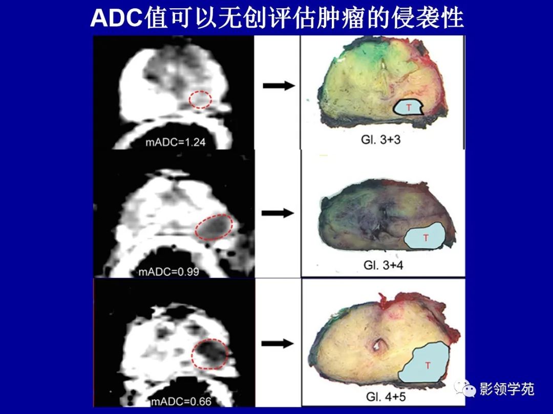 【PPT】前列腺癌MRI诊断再认识-107