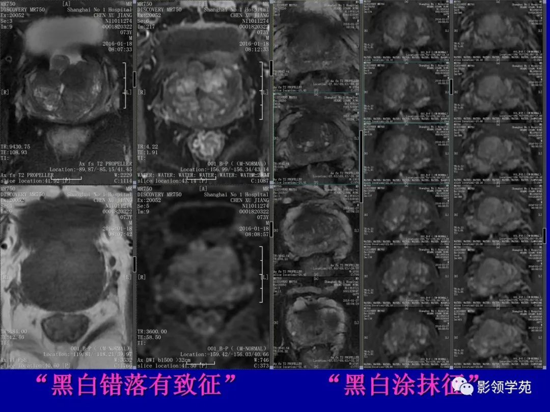【PPT】前列腺癌MRI诊断再认识-110