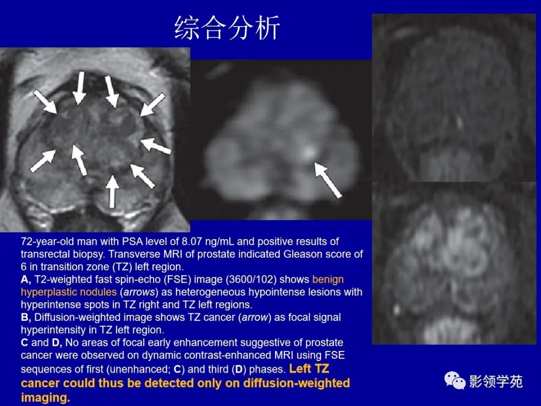 【PPT】前列腺癌MRI诊断再认识-114