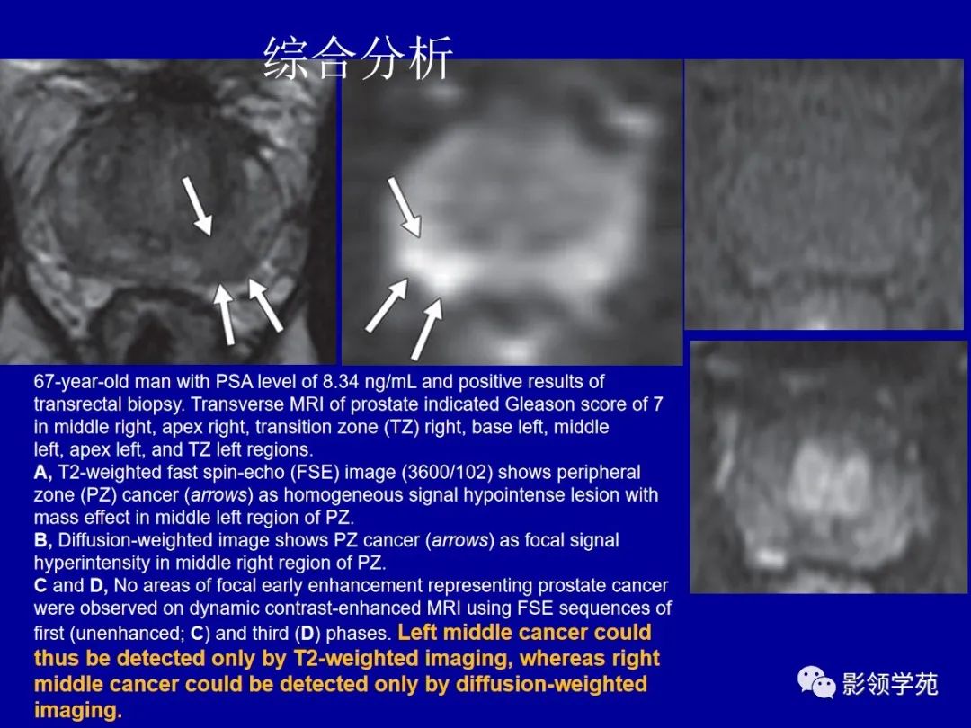 【PPT】前列腺癌MRI诊断再认识-113