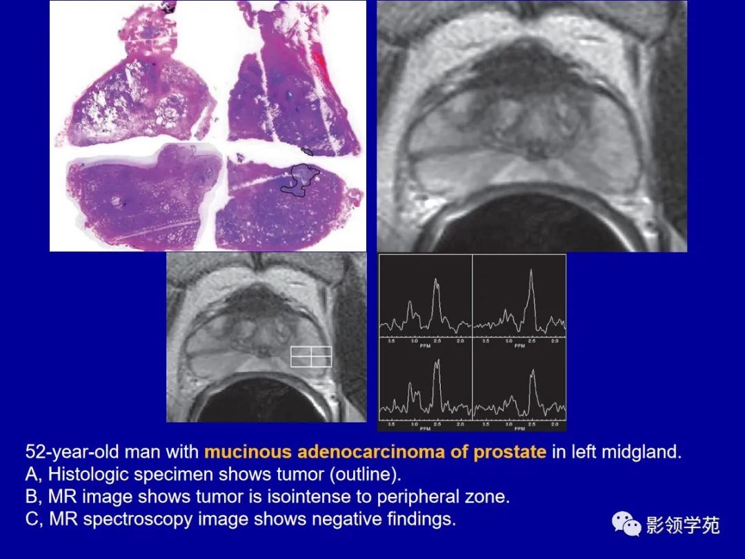 【PPT】前列腺癌MRI诊断再认识-117