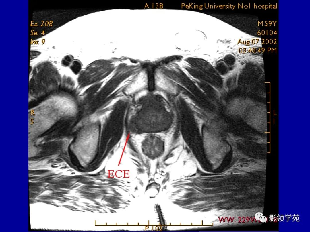 【PPT】前列腺癌MRI诊断再认识-123