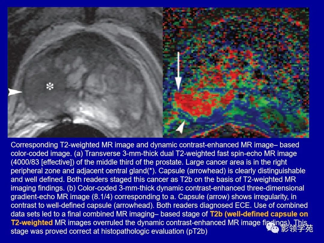 【PPT】前列腺癌MRI诊断再认识-122