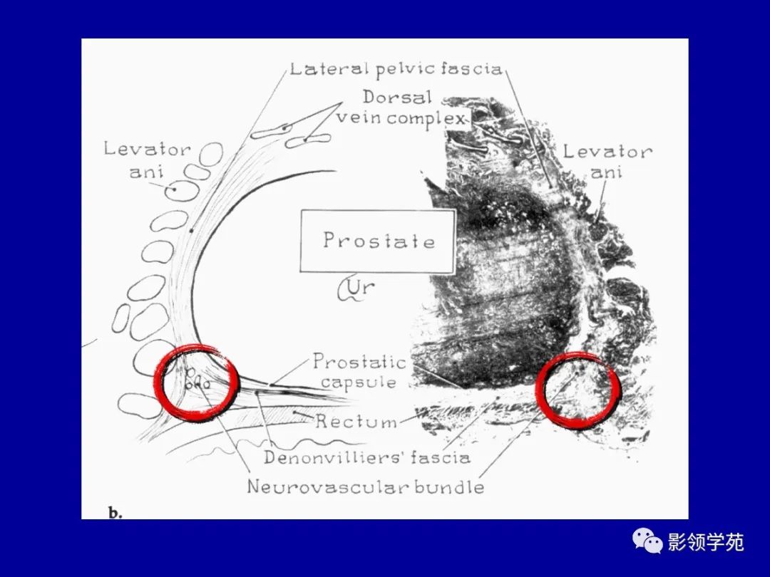 【PPT】前列腺癌MRI诊断再认识-126