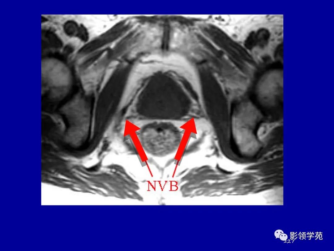 【PPT】前列腺癌MRI诊断再认识-127