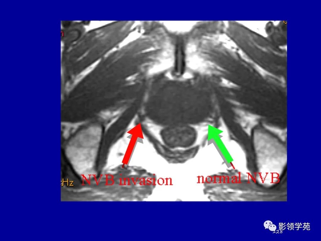 【PPT】前列腺癌MRI诊断再认识-128