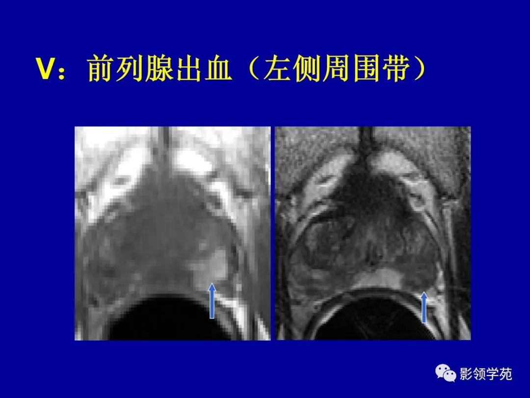 【PPT】前列腺癌MRI诊断再认识-132