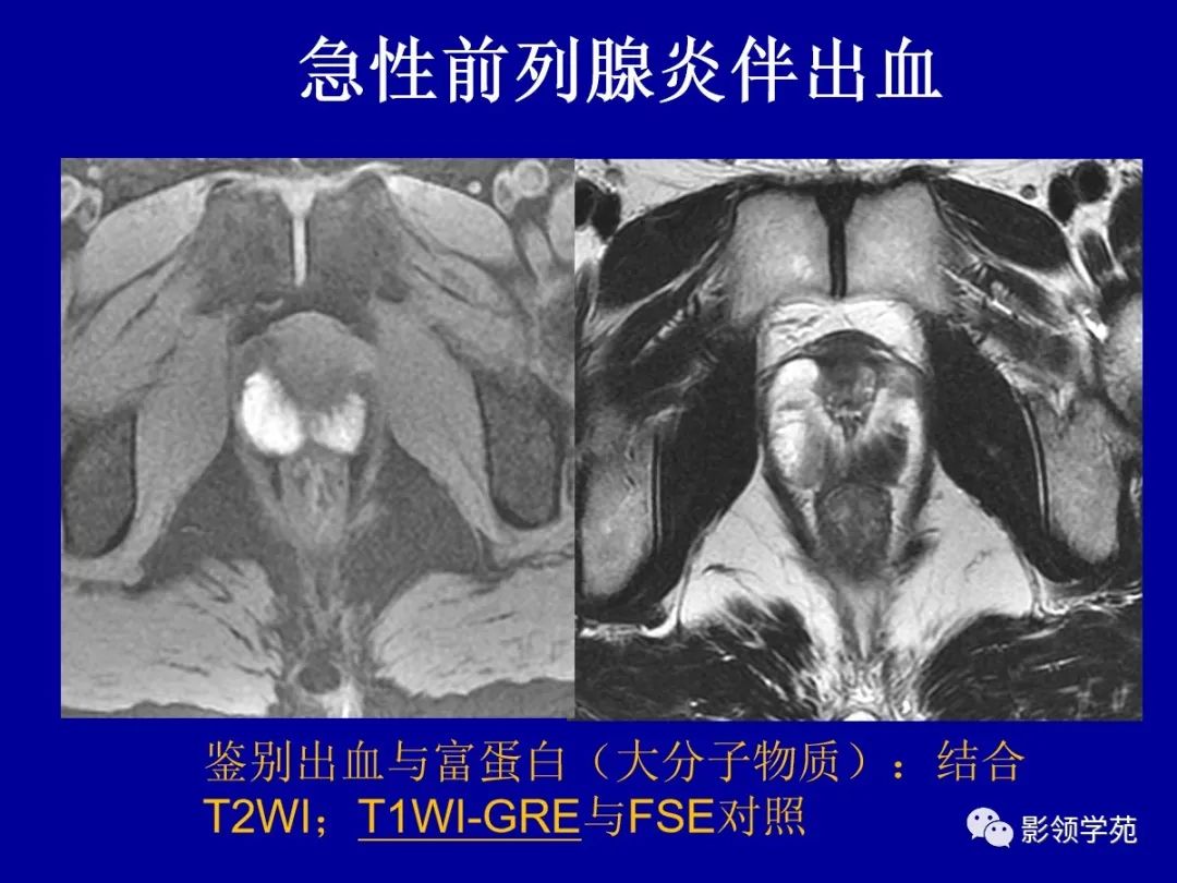 【PPT】前列腺癌MRI诊断再认识-133
