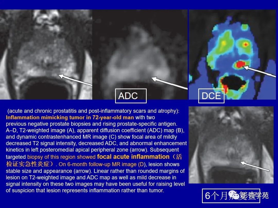 【PPT】前列腺癌MRI诊断再认识-138