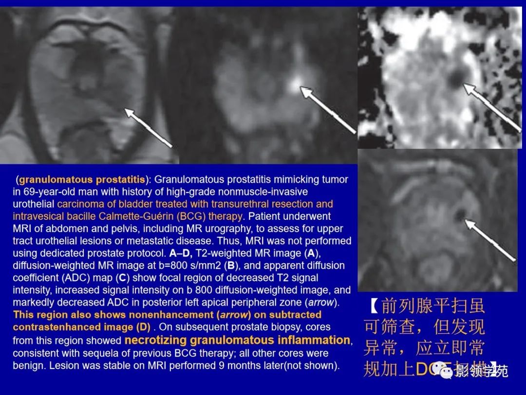 【PPT】前列腺癌MRI诊断再认识-139