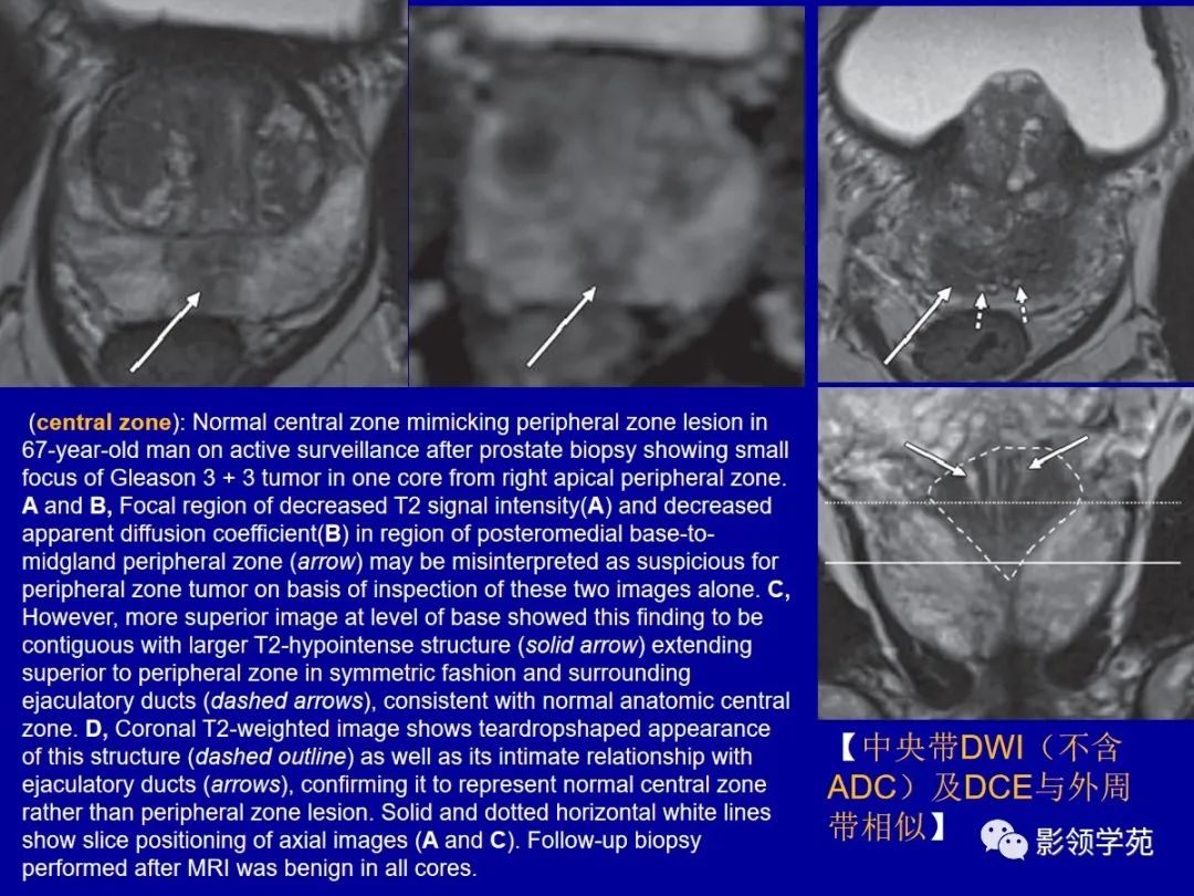 【PPT】前列腺癌MRI诊断再认识-141