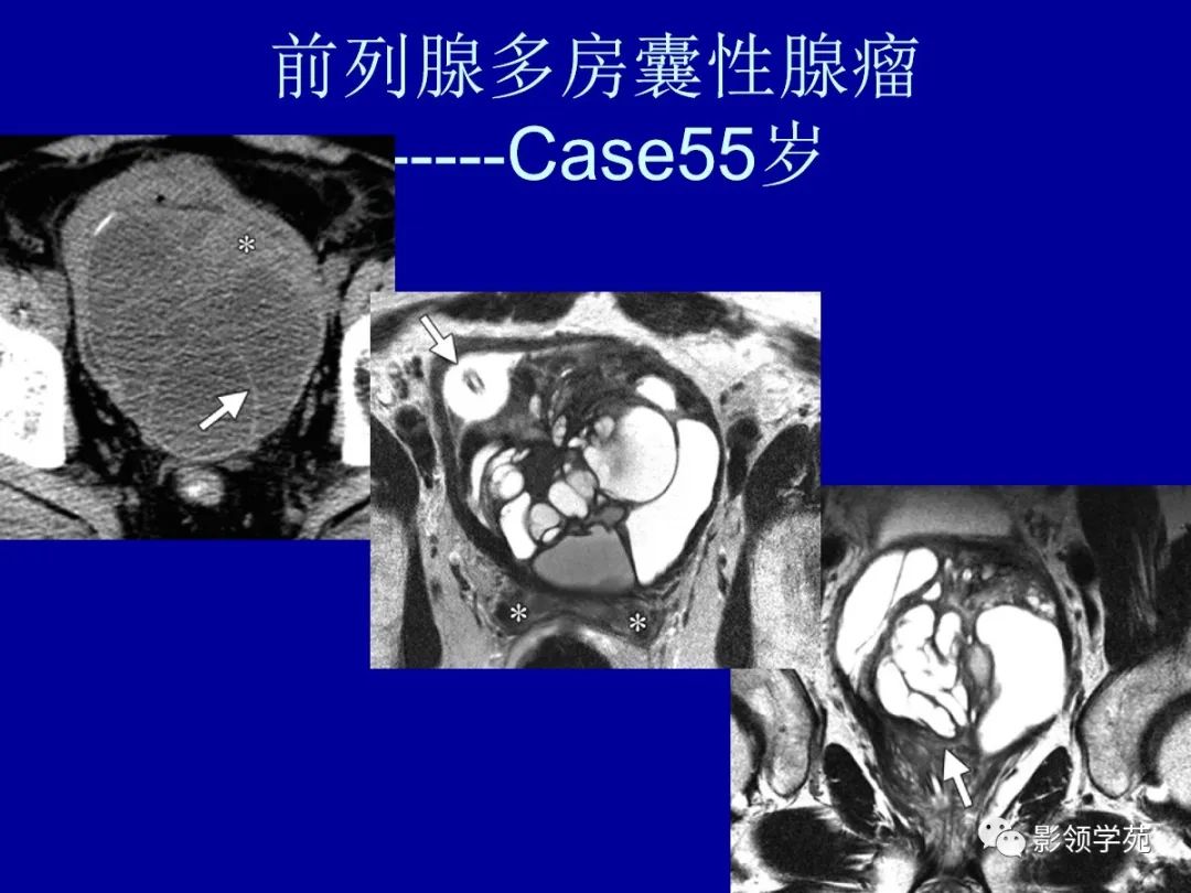 【PPT】前列腺癌MRI诊断再认识-147