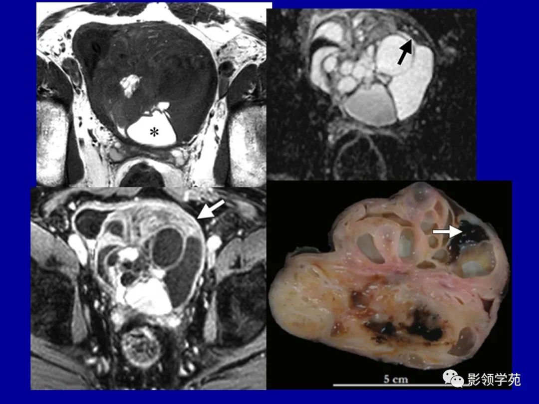【PPT】前列腺癌MRI诊断再认识-148