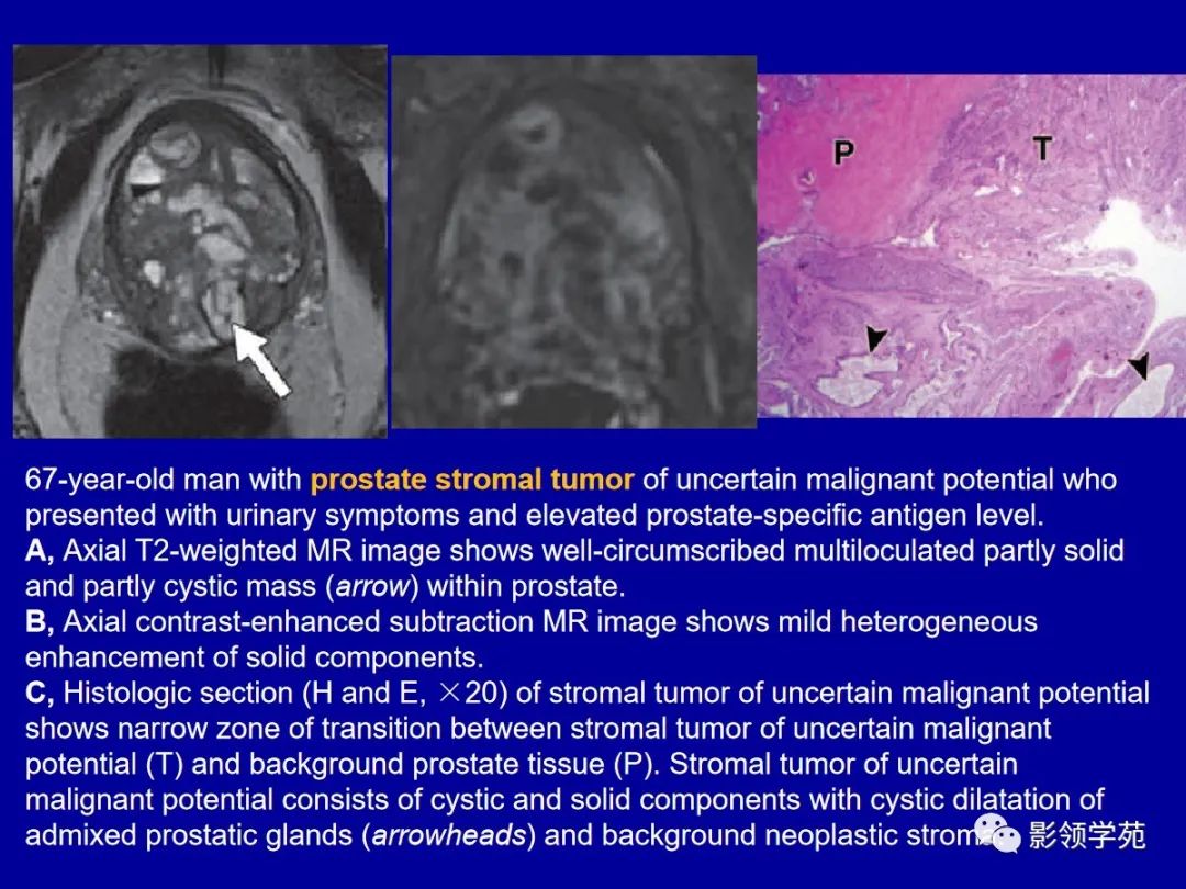 【PPT】前列腺癌MRI诊断再认识-150
