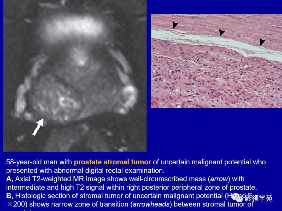 【PPT】前列腺癌MRI诊断再认识-151