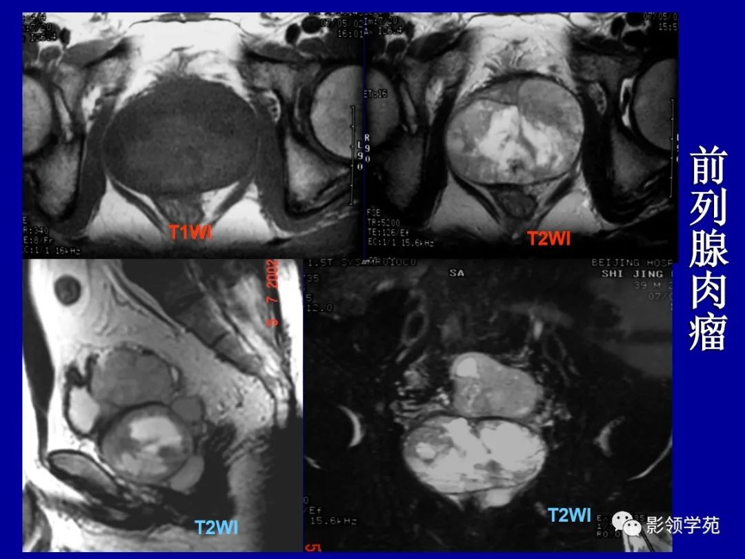 【PPT】前列腺癌MRI诊断再认识-154
