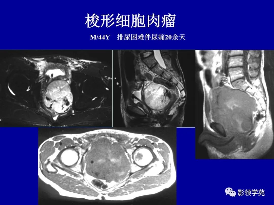 【PPT】前列腺癌MRI诊断再认识-155