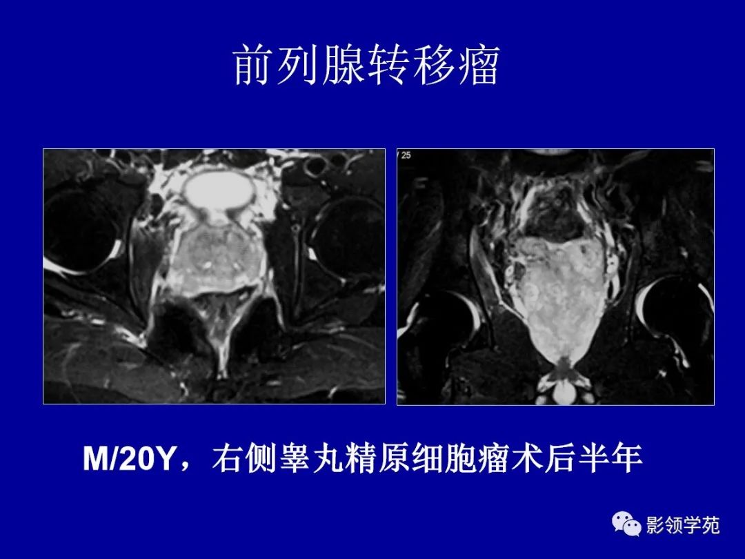 【PPT】前列腺癌MRI诊断再认识-157