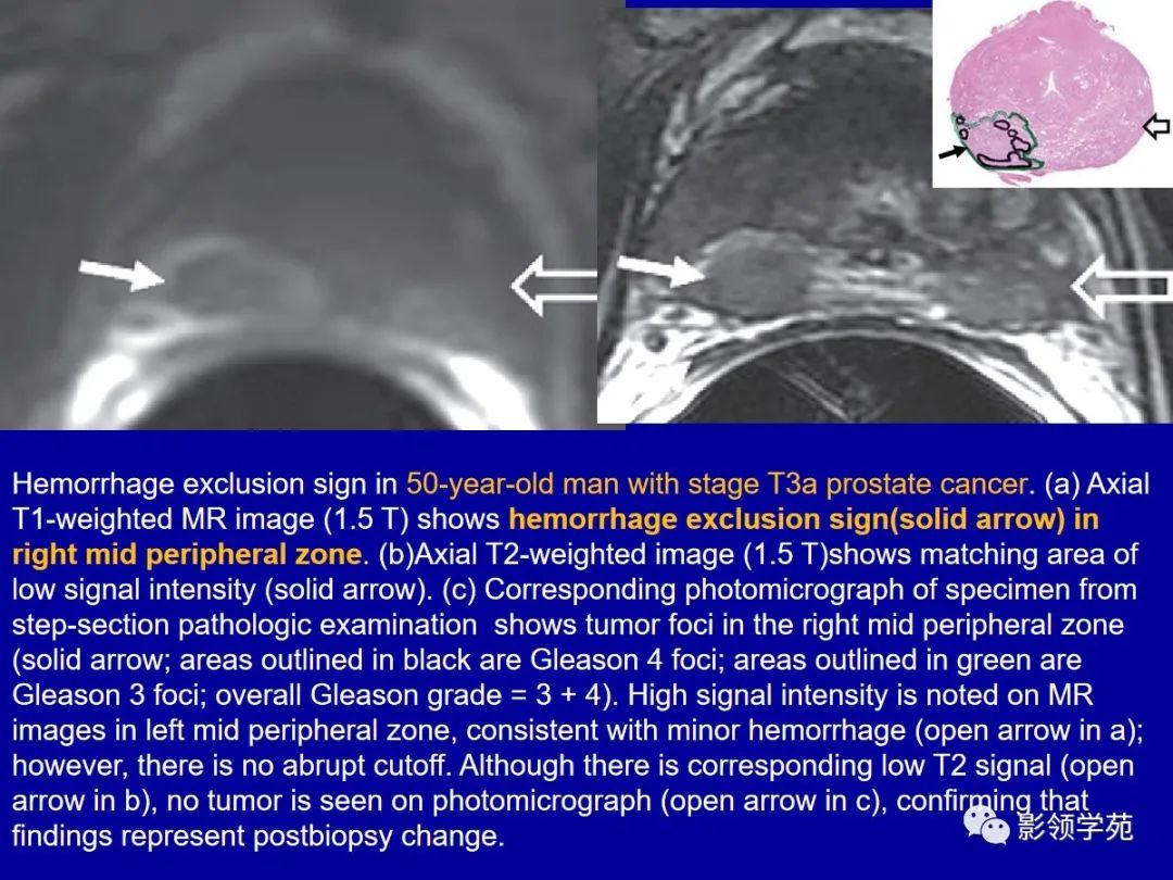 【PPT】前列腺癌MRI诊断再认识-159