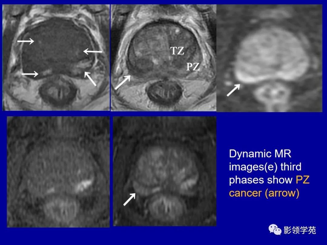【PPT】前列腺癌MRI诊断再认识-160
