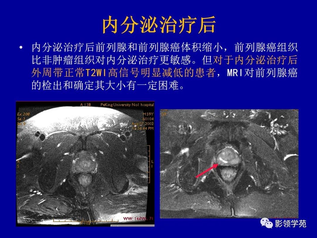 【PPT】前列腺癌MRI诊断再认识-167