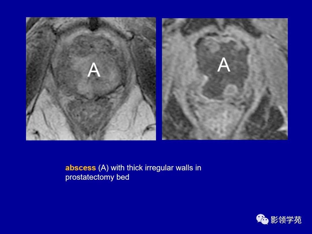 【PPT】前列腺癌MRI诊断再认识-166