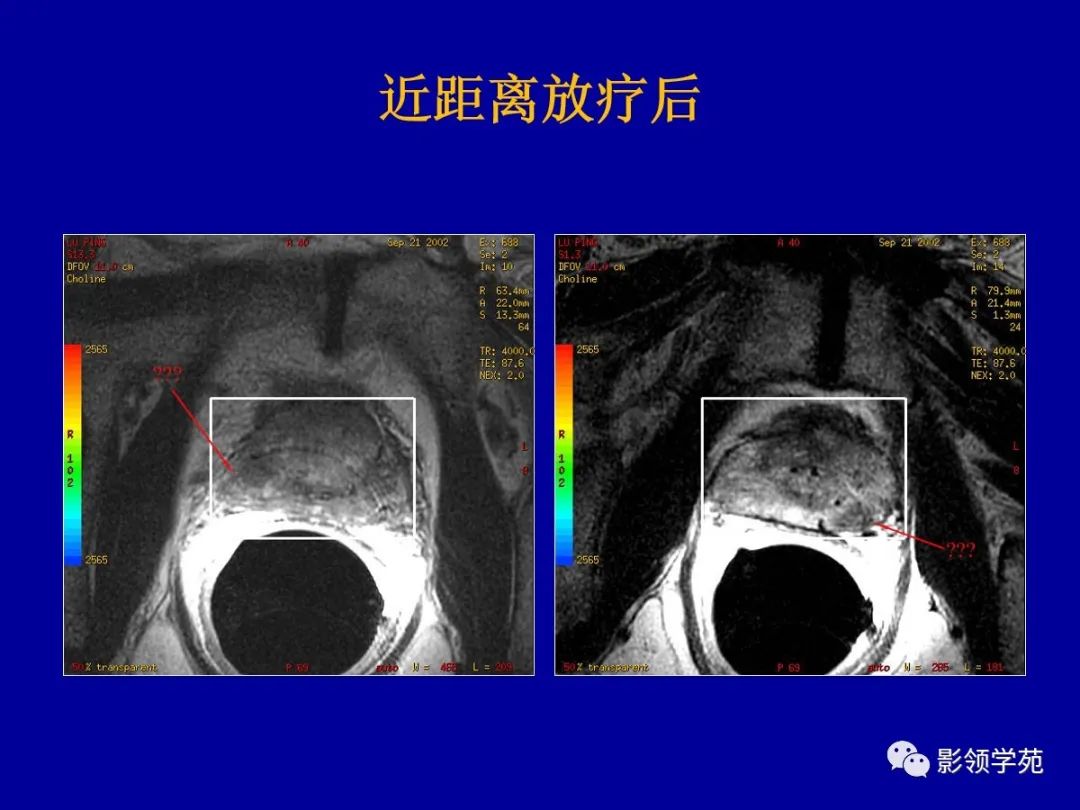 【PPT】前列腺癌MRI诊断再认识-168
