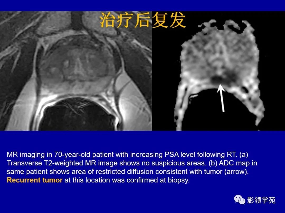 【PPT】前列腺癌MRI诊断再认识-169