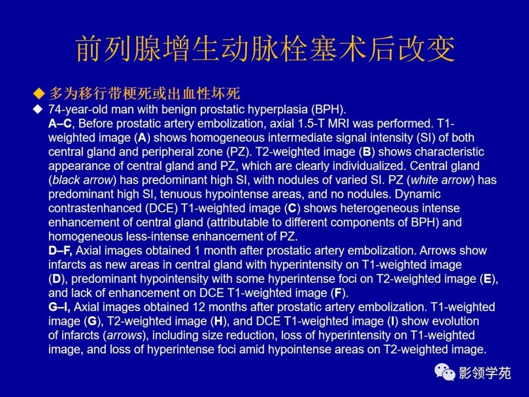 【PPT】前列腺癌MRI诊断再认识-170