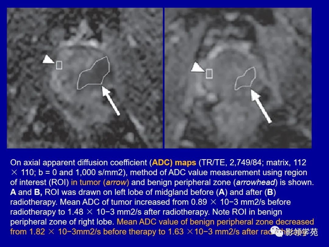 【PPT】前列腺癌MRI诊断再认识-172