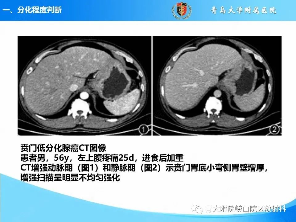 【PPT】CT对胃癌诊断和临床应用价值-7