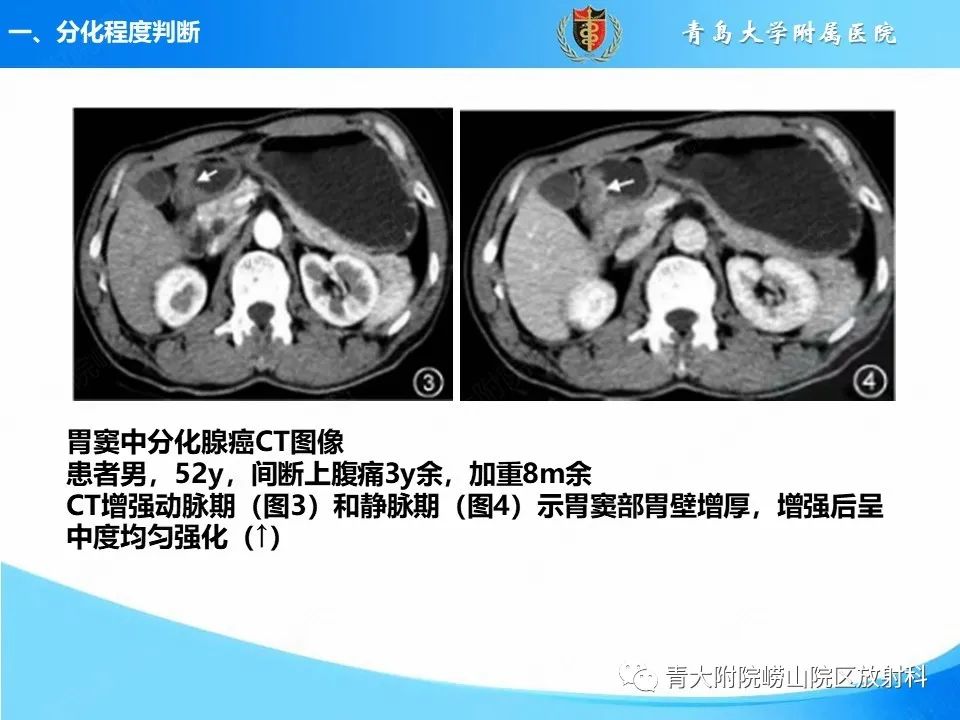 【PPT】CT对胃癌诊断和临床应用价值-8