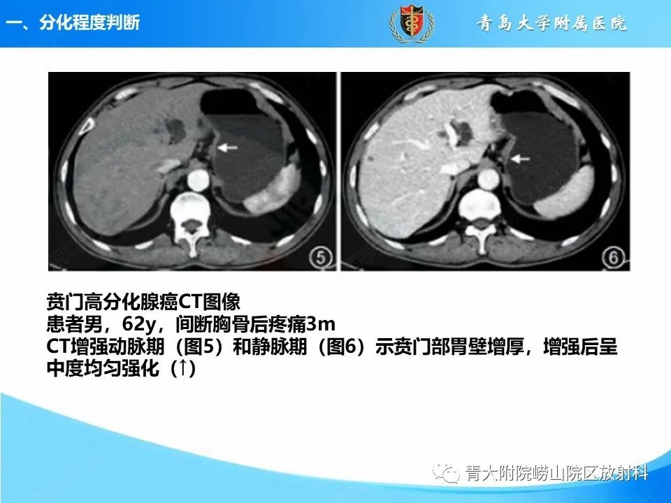 【PPT】CT对胃癌诊断和临床应用价值-9