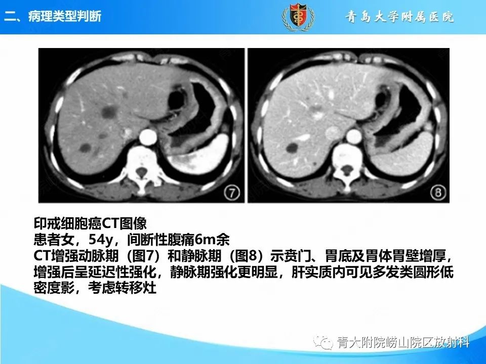 【PPT】CT对胃癌诊断和临床应用价值-15