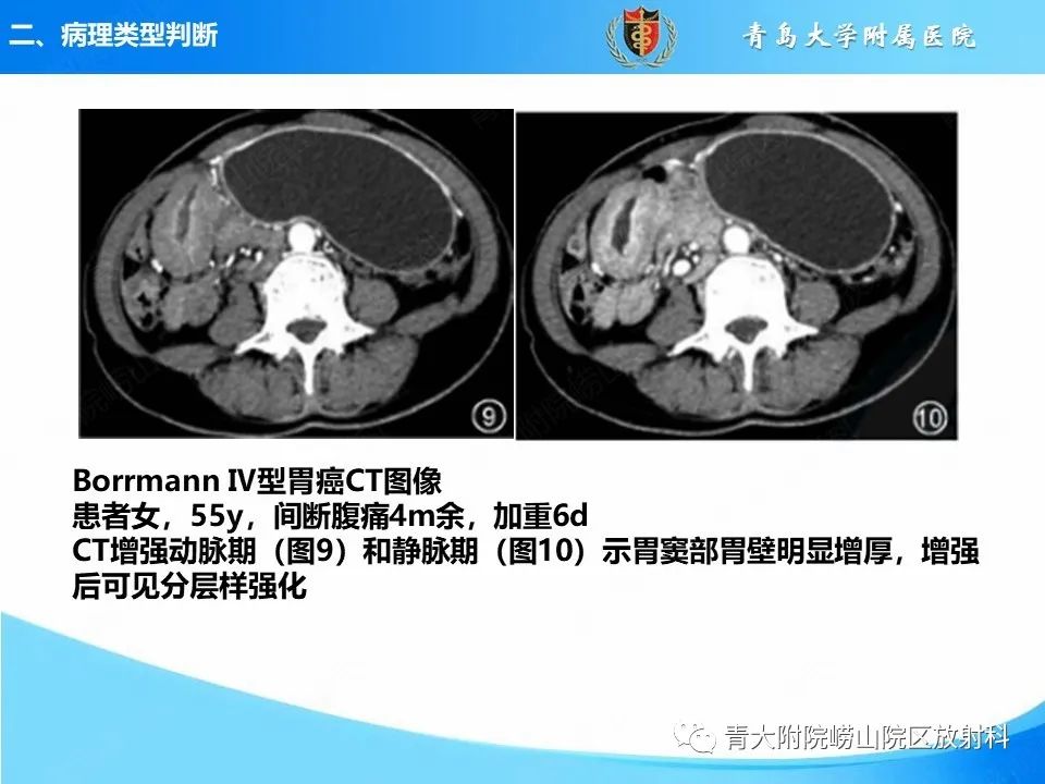 【PPT】CT对胃癌诊断和临床应用价值-17