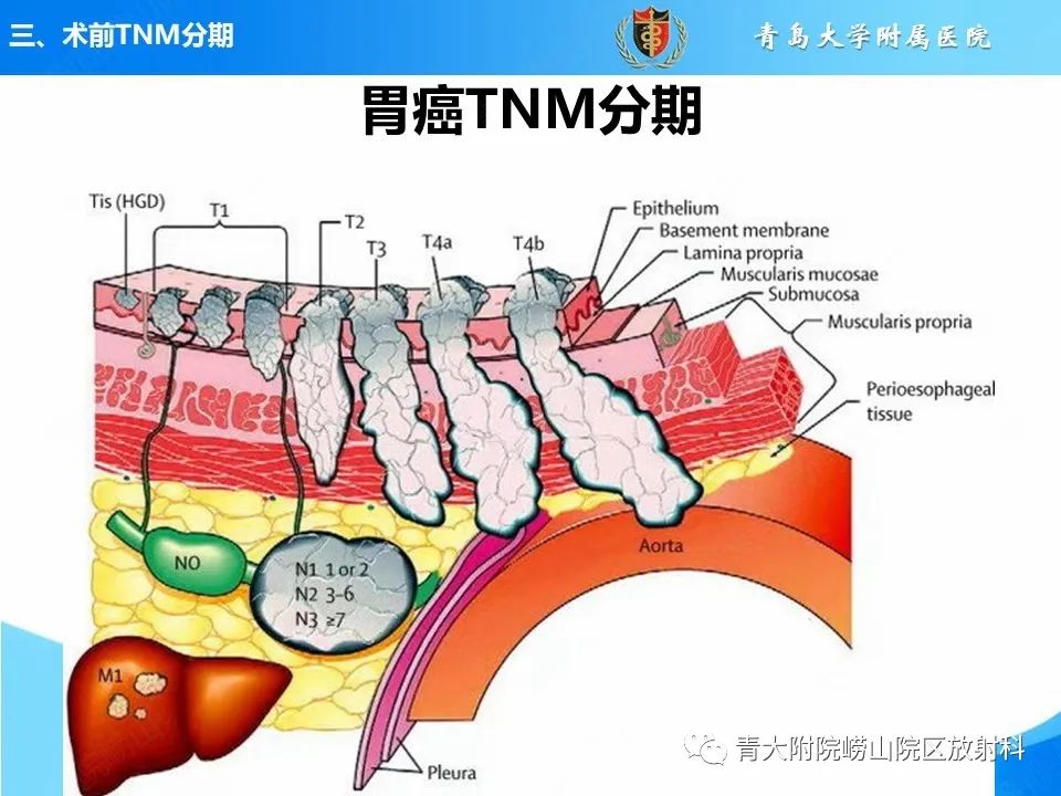 【PPT】CT对胃癌诊断和临床应用价值-21