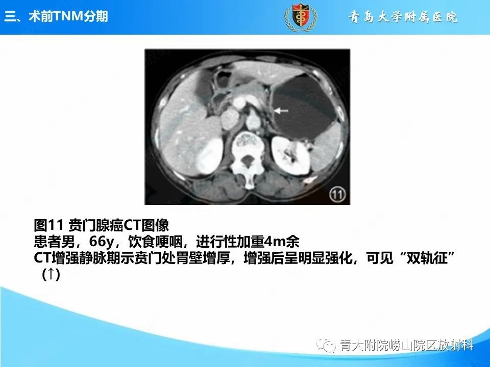 【PPT】CT对胃癌诊断和临床应用价值-24