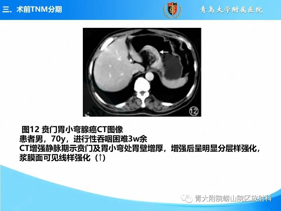 【PPT】CT对胃癌诊断和临床应用价值-26