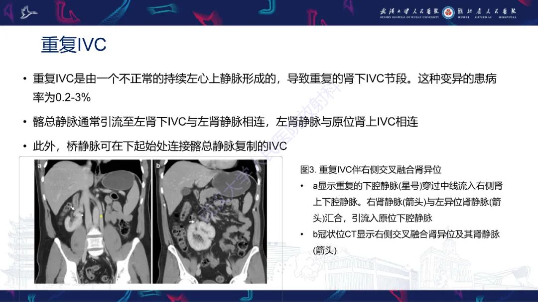 【PPT】下腔静脉解剖变异及病变影像诊断-7