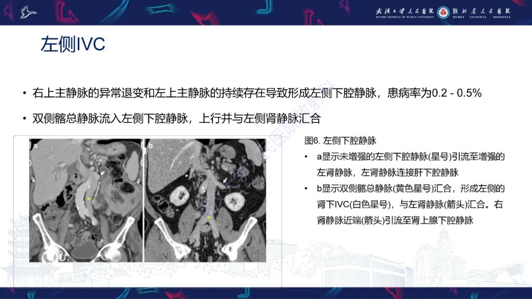 【PPT】下腔静脉解剖变异及病变影像诊断-9
