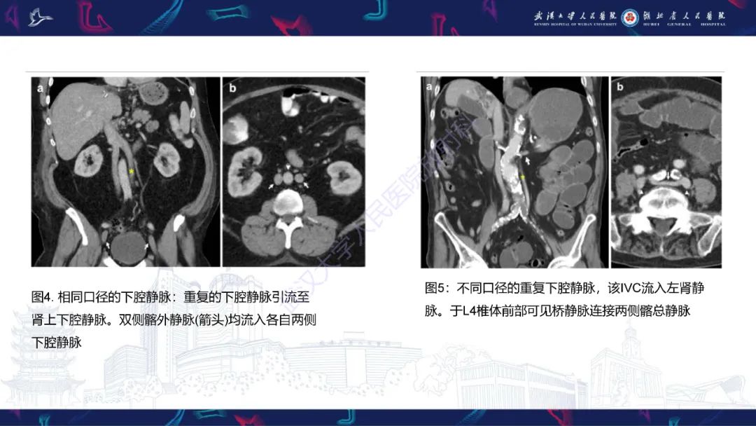 【PPT】下腔静脉解剖变异及病变影像诊断-8