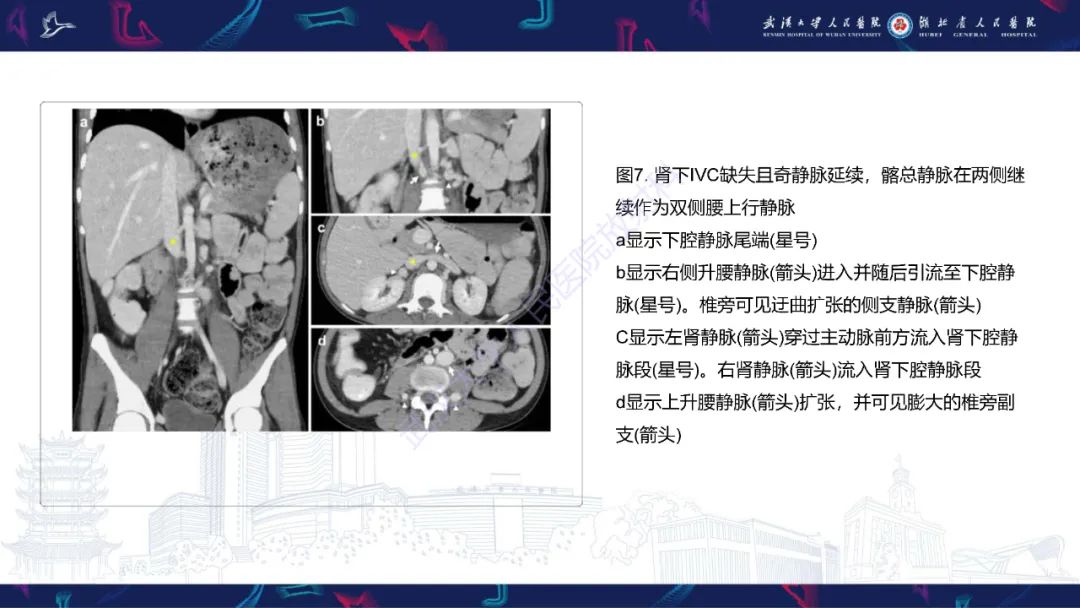 【PPT】下腔静脉解剖变异及病变影像诊断-11