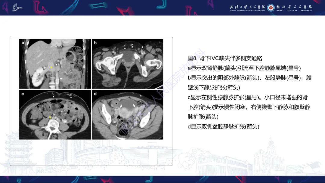 【PPT】下腔静脉解剖变异及病变影像诊断-12