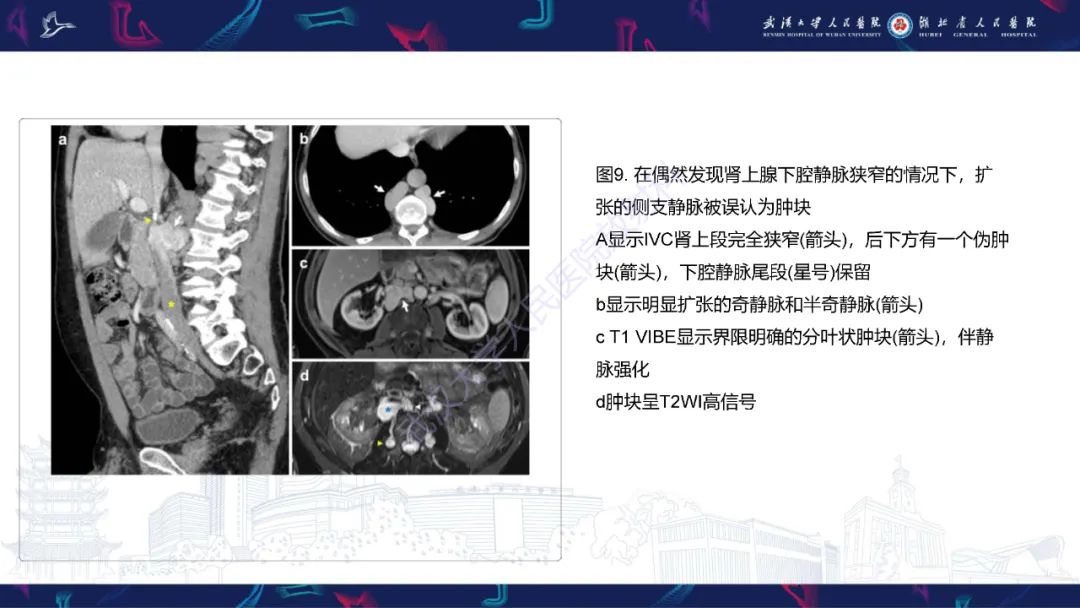 【PPT】下腔静脉解剖变异及病变影像诊断-14