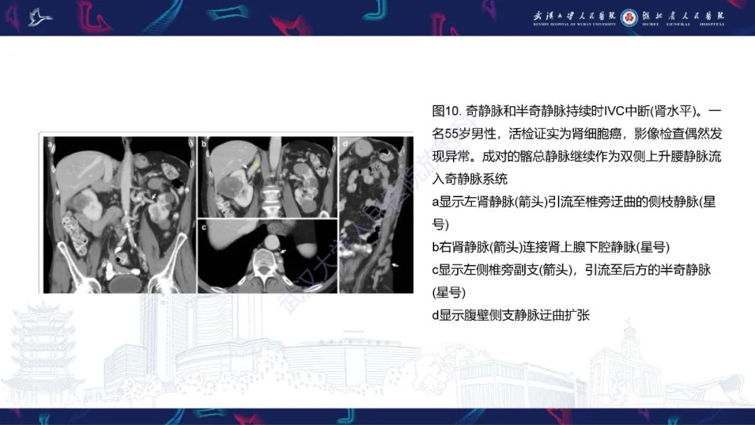 【PPT】下腔静脉解剖变异及病变影像诊断-15