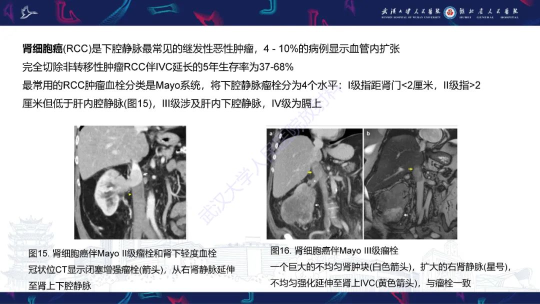 【PPT】下腔静脉解剖变异及病变影像诊断-20
